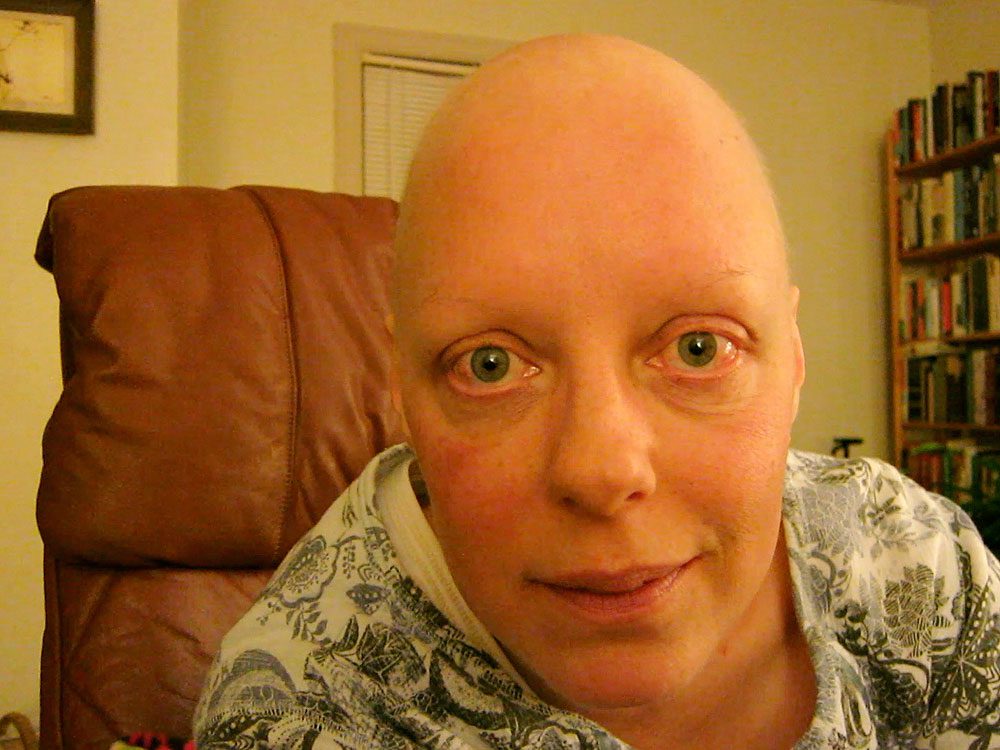 Chemo side effects: Loss of eyebrows and eyelashes