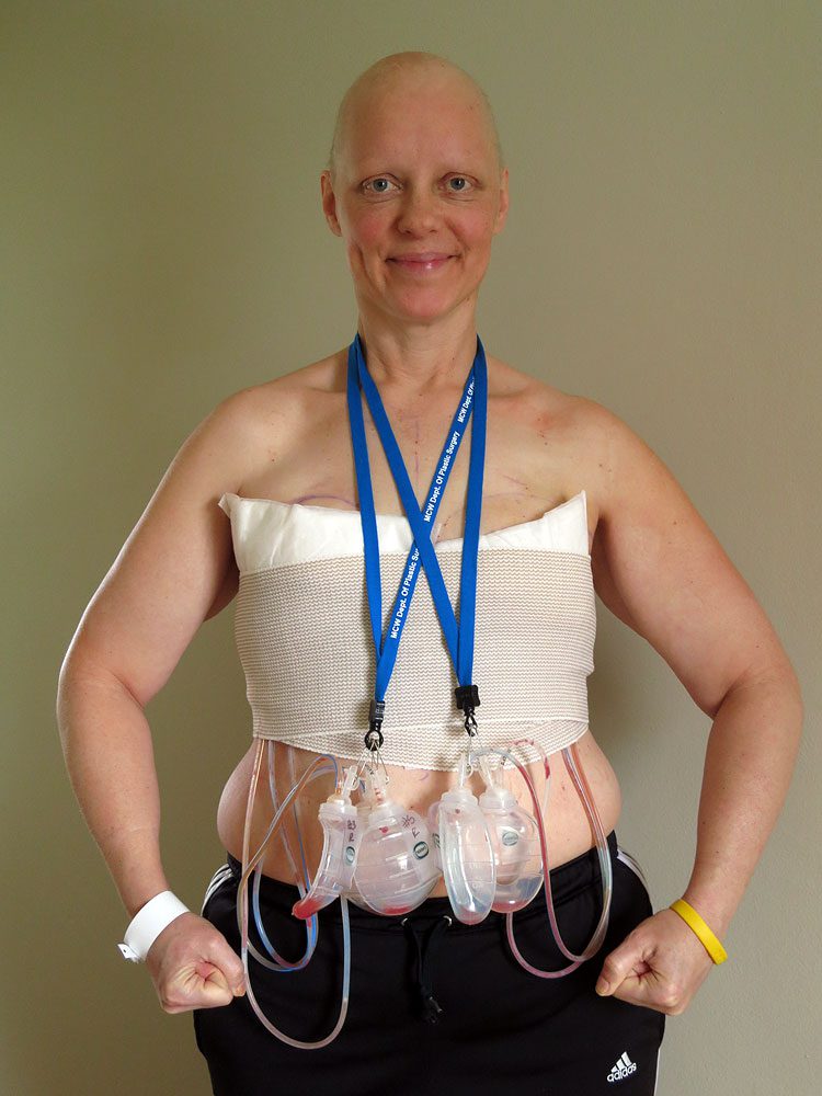 Breast cancer patient Amy Czerniec with Jackson-Pratt drains after a double mastectomy
